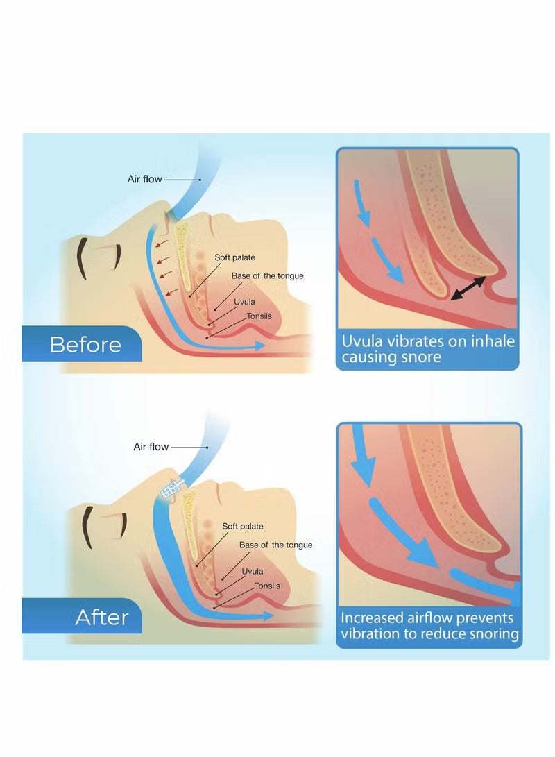 Anti Snoring Mouth Guard Device